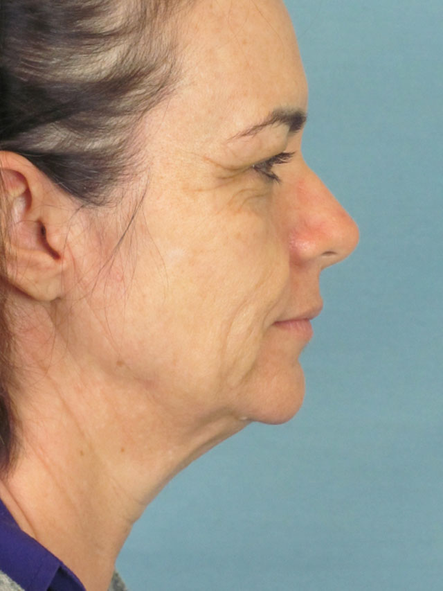 Charleston Custom Lift Facelift Before and After | Thomas Funcik MD