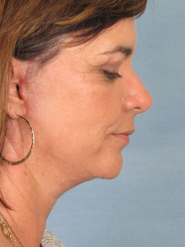 Charleston Custom Lift Facelift Before and After | Thomas Funcik MD