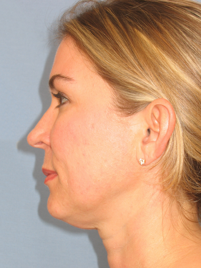 Charleston Custom Lift Facelift Before and After | Thomas Funcik MD