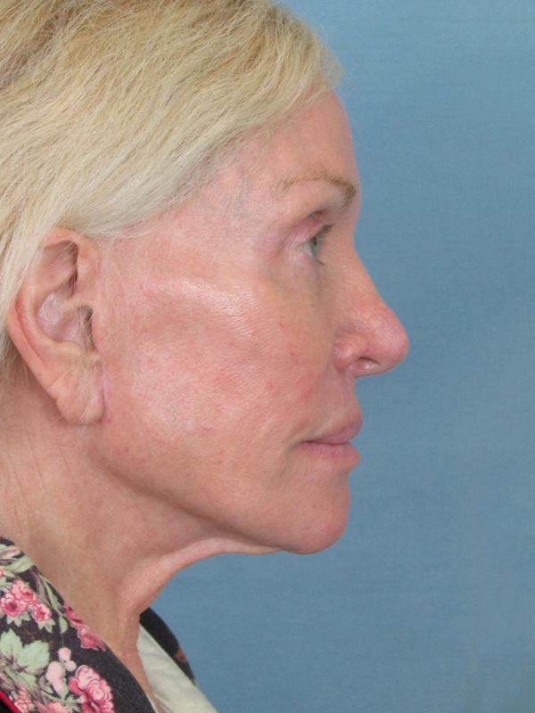 Charleston Custom Lift Facelift Before and After | Thomas Funcik MD