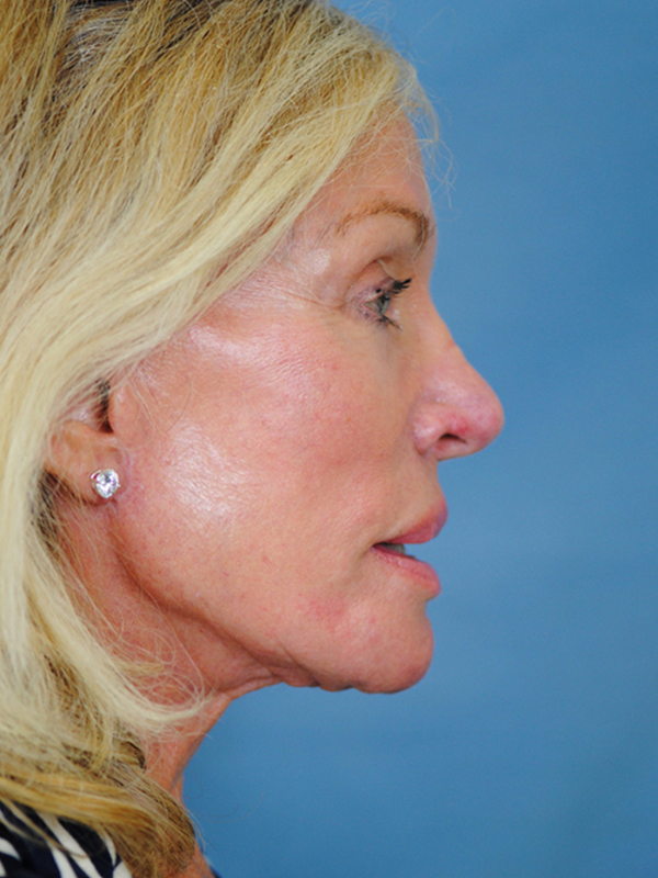 Charleston Custom Lift Facelift Before and After | Thomas Funcik MD