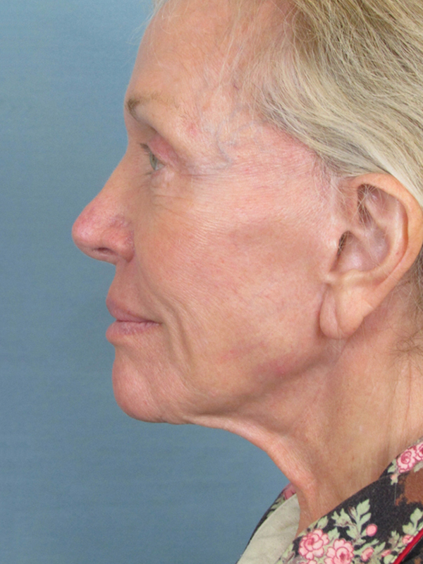 Charleston Custom Lift Facelift Before and After | Thomas Funcik MD