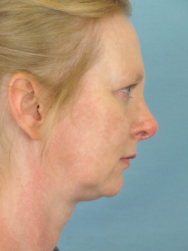 Charleston Custom Lift Facelift Before and After | Thomas Funcik MD