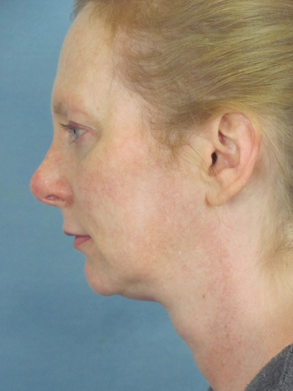 Charleston Custom Lift Facelift Before and After | Thomas Funcik MD