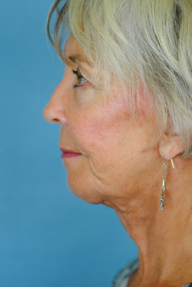 Charleston Custom Lift Facelift Before and After | Thomas Funcik MD