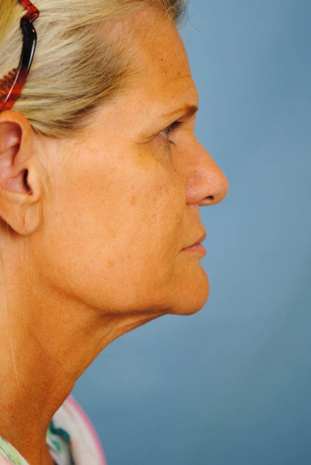 Charleston Custom Lift Facelift Before and After | Thomas Funcik MD