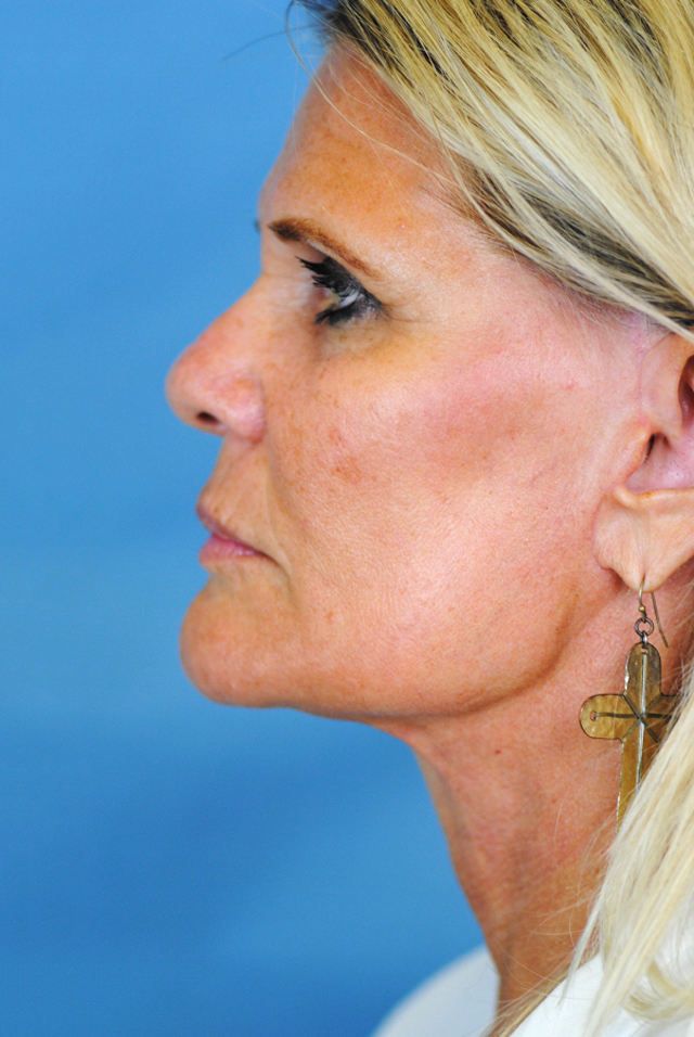 Charleston Custom Lift Facelift Before and After | Thomas Funcik MD