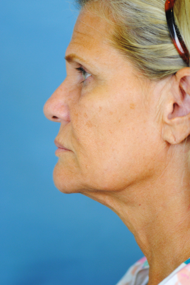 Charleston Custom Lift Facelift Before and After | Thomas Funcik MD