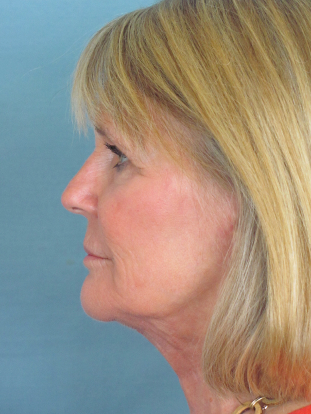 Charleston Custom Lift Facelift Before and After | Thomas Funcik MD