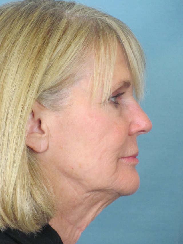 Charleston Custom Lift Facelift Before and After | Thomas Funcik MD