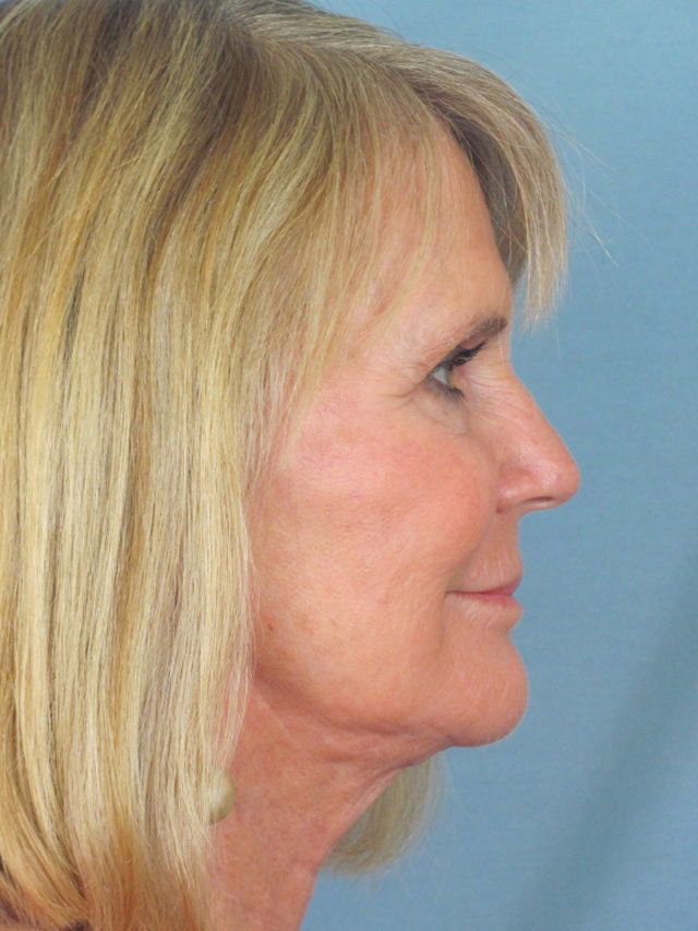 Charleston Custom Lift Facelift Before and After | Thomas Funcik MD