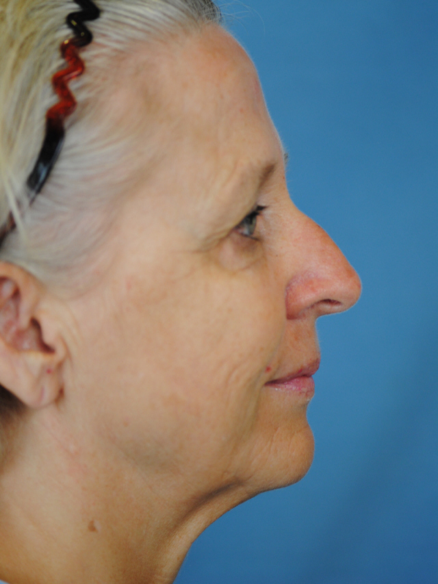 Charleston Custom Lift Facelift Before and After | Thomas Funcik MD