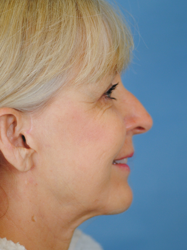 Charleston Custom Lift Facelift Before and After | Thomas Funcik MD