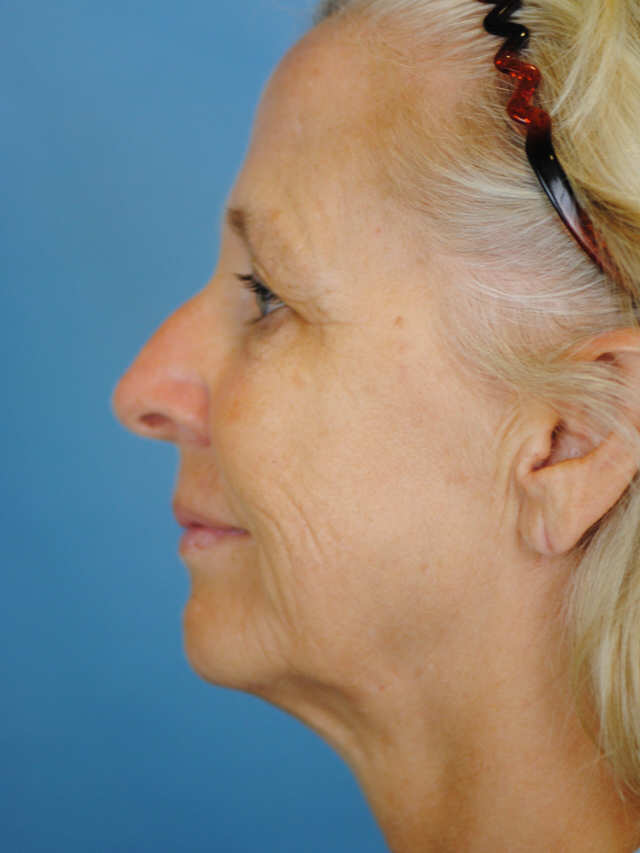 Charleston Custom Lift Facelift Before and After | Thomas Funcik MD