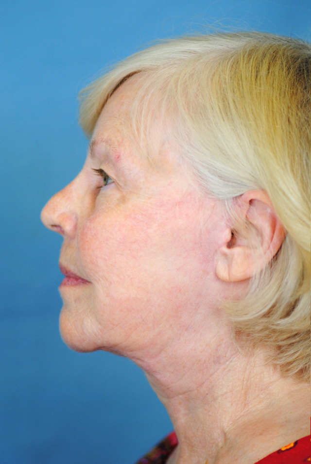 Charleston Custom Lift Facelift Before and After | Thomas Funcik MD