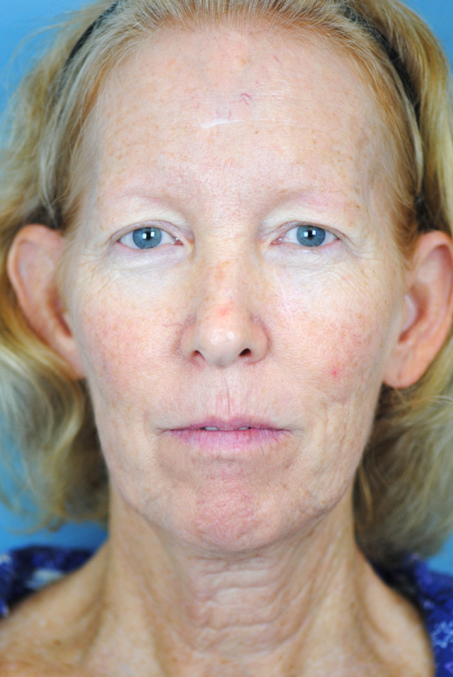 Charleston Custom Lift Facelift Before and After | Thomas Funcik MD