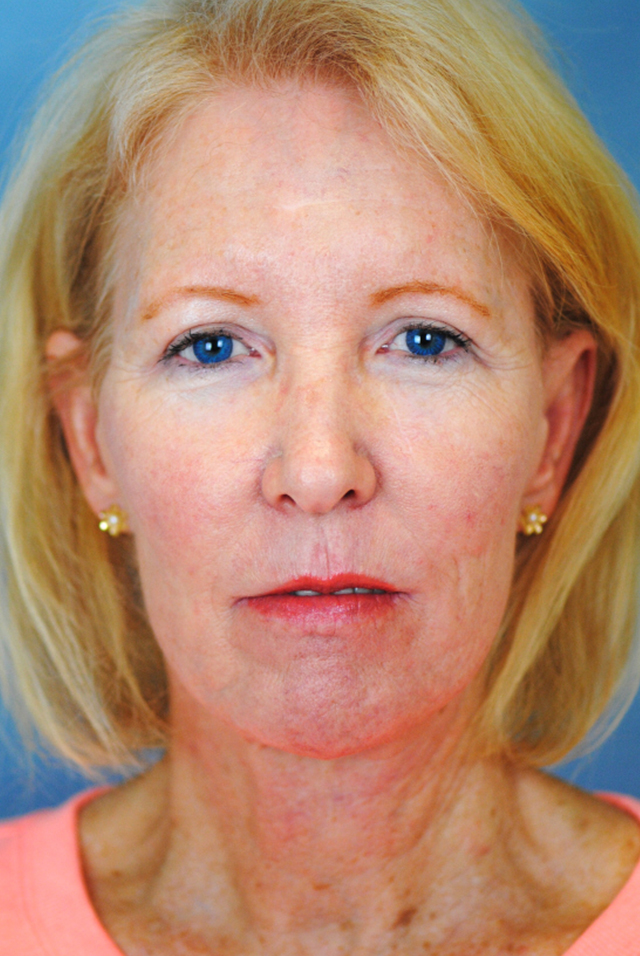 Charleston Custom Lift Facelift Before and After | Thomas Funcik MD