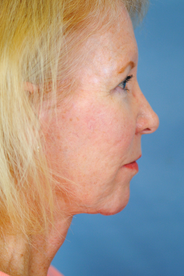 Charleston Custom Lift Facelift Before and After | Thomas Funcik MD