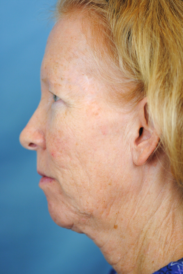 Charleston Custom Lift Facelift Before and After | Thomas Funcik MD