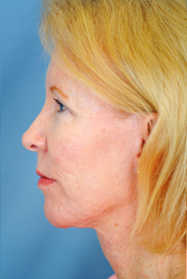 Charleston Custom Lift Facelift Before and After | Thomas Funcik MD