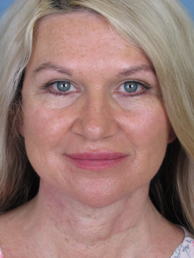 Charleston Custom Lift Facelift Before and After | Thomas Funcik MD