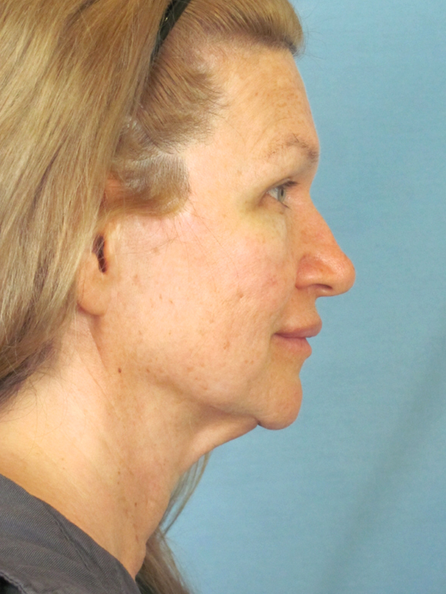 Charleston Custom Lift Facelift Before and After | Thomas Funcik MD