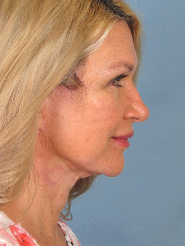 Charleston Custom Lift Facelift Before and After | Thomas Funcik MD