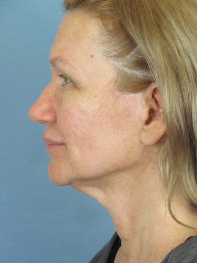 Charleston Custom Lift Facelift Before and After | Thomas Funcik MD