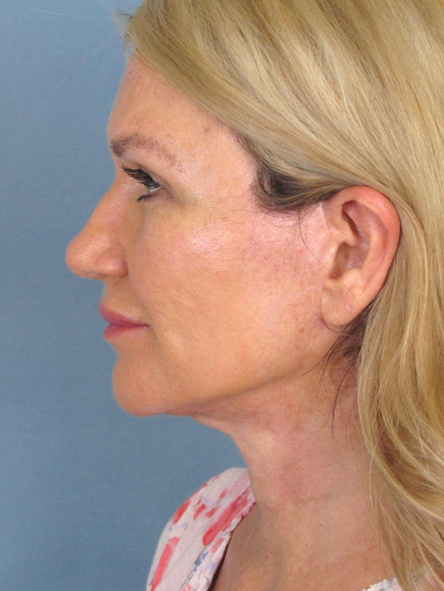 Charleston Custom Lift Facelift Before and After | Thomas Funcik MD