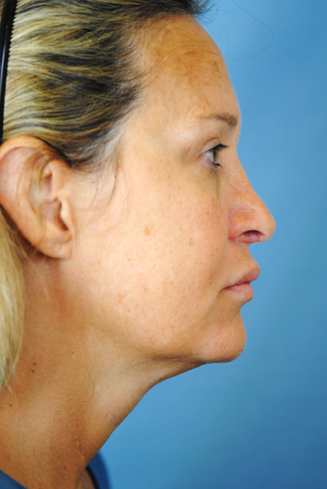 Charleston Custom Lift Facelift Before and After | Thomas Funcik MD