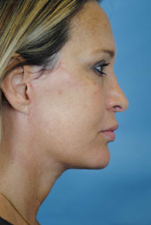 Charleston Custom Lift Facelift Before and After | Thomas Funcik MD