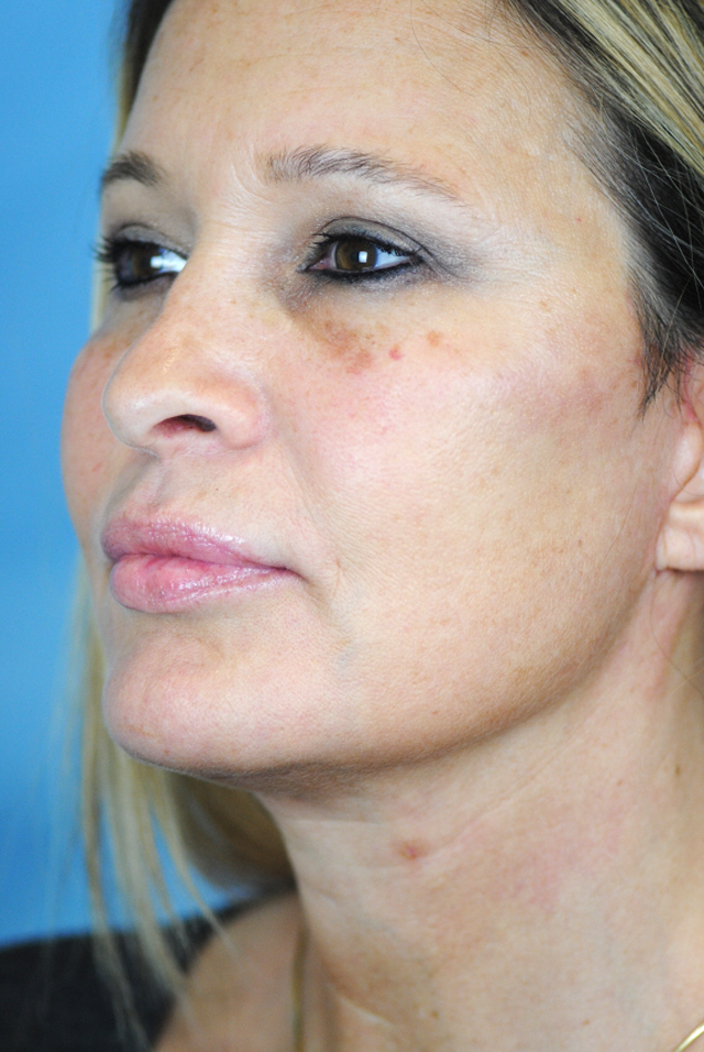 Charleston Custom Lift Facelift Before and After | Thomas Funcik MD