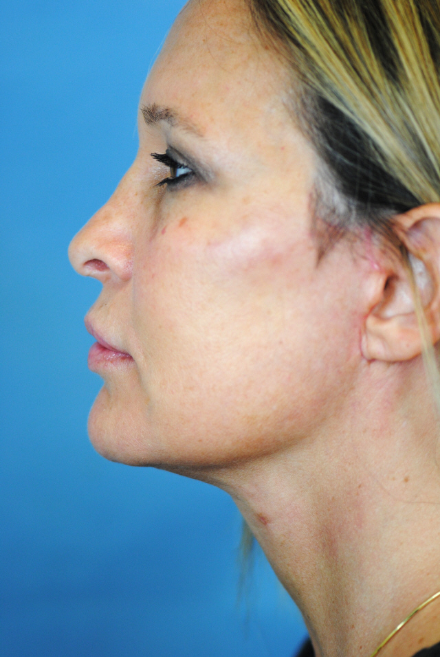 Charleston Custom Lift Facelift Before and After | Thomas Funcik MD