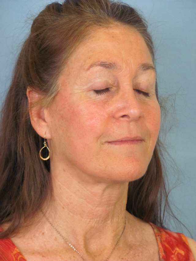 Charleston Custom Lift Facelift Before and After | Thomas Funcik MD