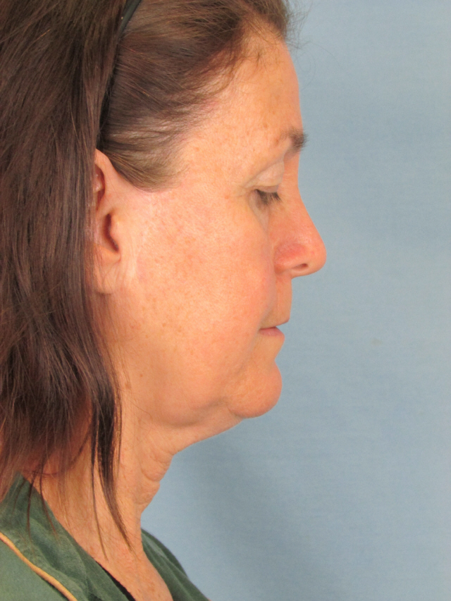 Charleston Custom Lift Facelift Before and After | Thomas Funcik MD