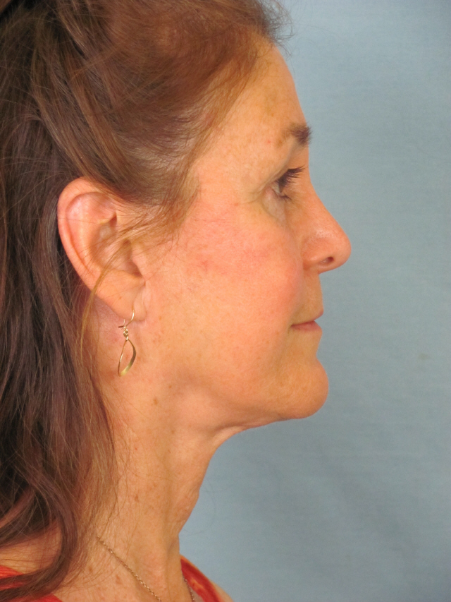 Charleston Custom Lift Facelift Before and After | Thomas Funcik MD