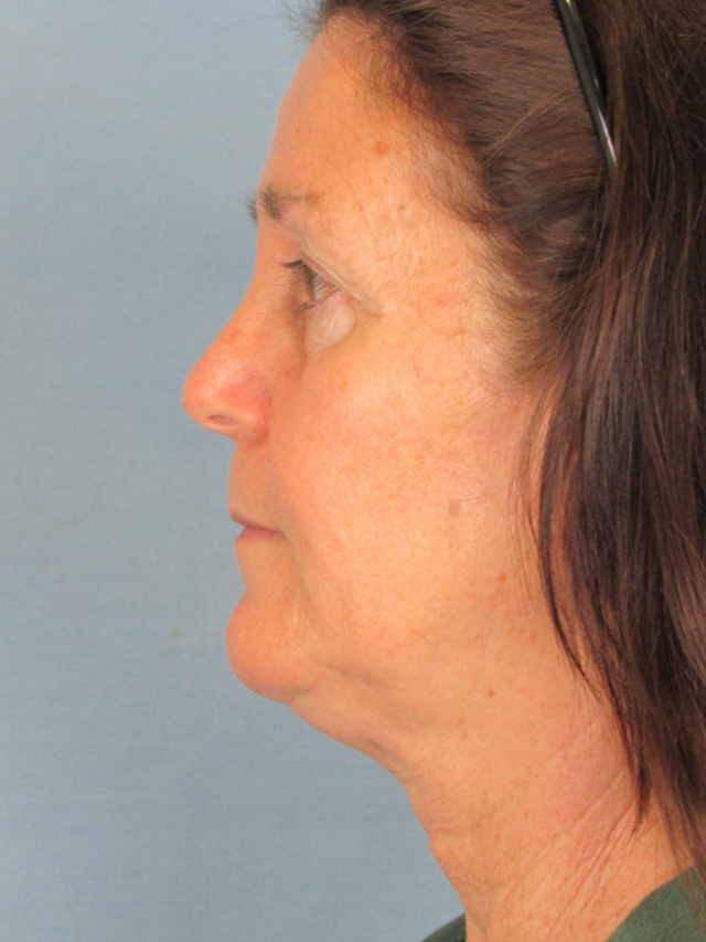 Charleston Custom Lift Facelift Before and After | Thomas Funcik MD