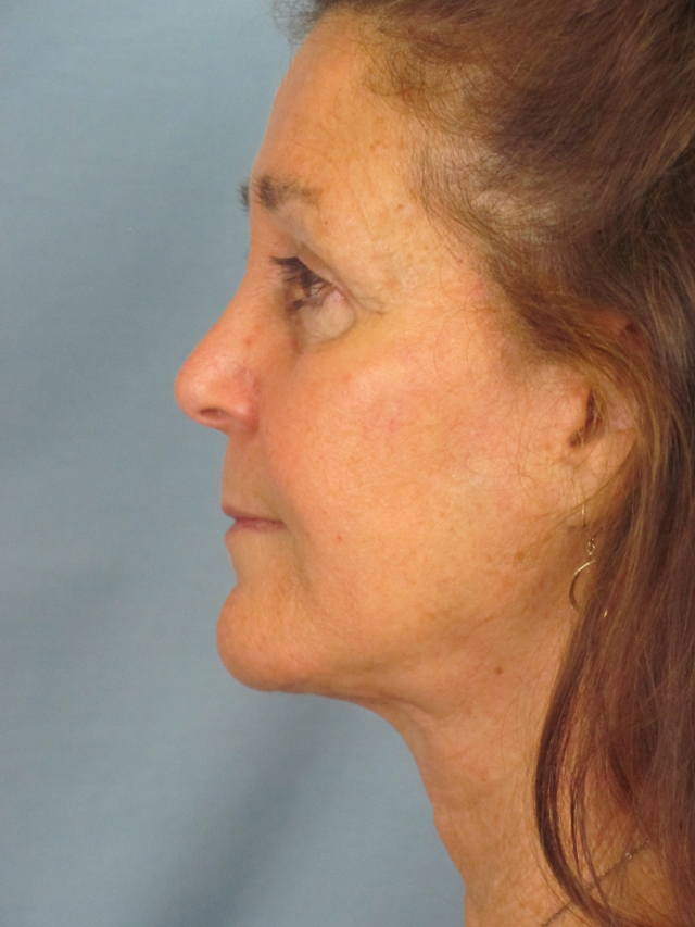 Charleston Custom Lift Facelift Before and After | Thomas Funcik MD