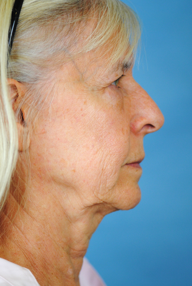 Charleston Custom Lift Facelift Before and After | Thomas Funcik MD