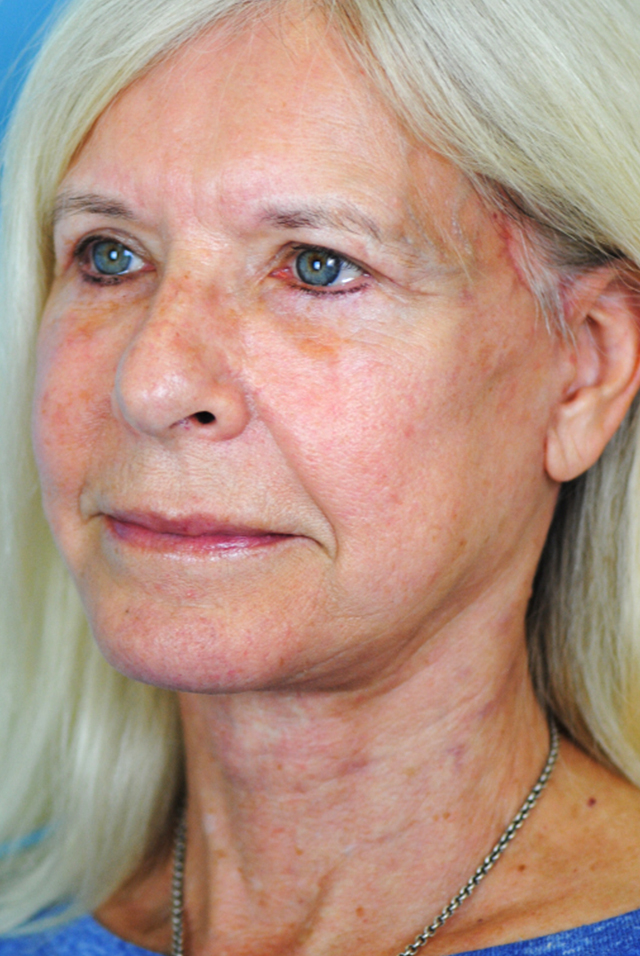 Charleston Custom Lift Facelift Before and After | Thomas Funcik MD