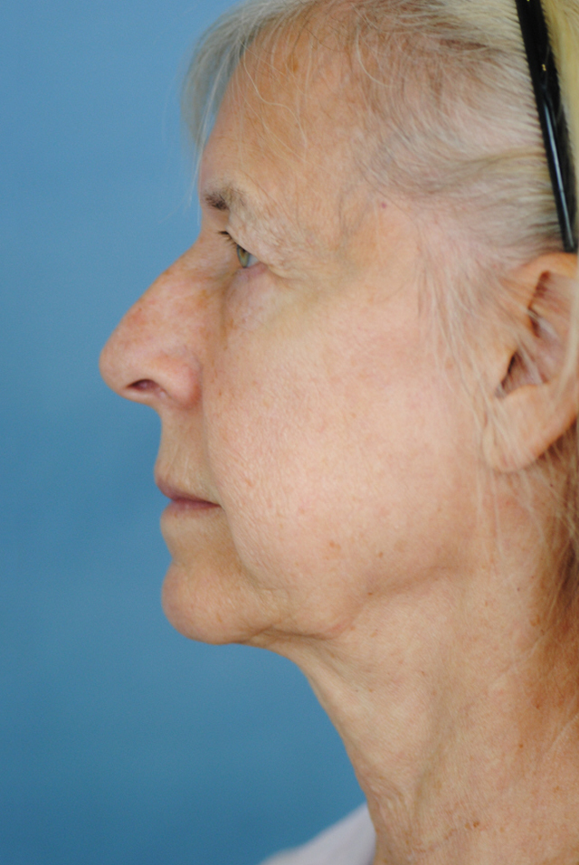 Charleston Custom Lift Facelift Before and After | Thomas Funcik MD