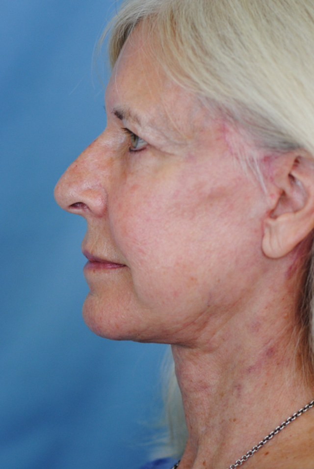 Charleston Custom Lift Facelift Before and After | Thomas Funcik MD