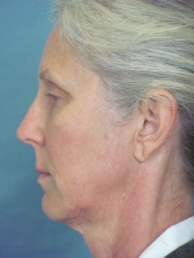 Charleston Custom Lift Facelift Before and After | Thomas Funcik MD