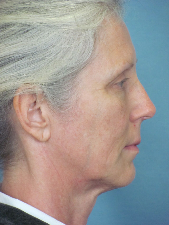 Charleston Custom Lift Facelift Before and After | Thomas Funcik MD