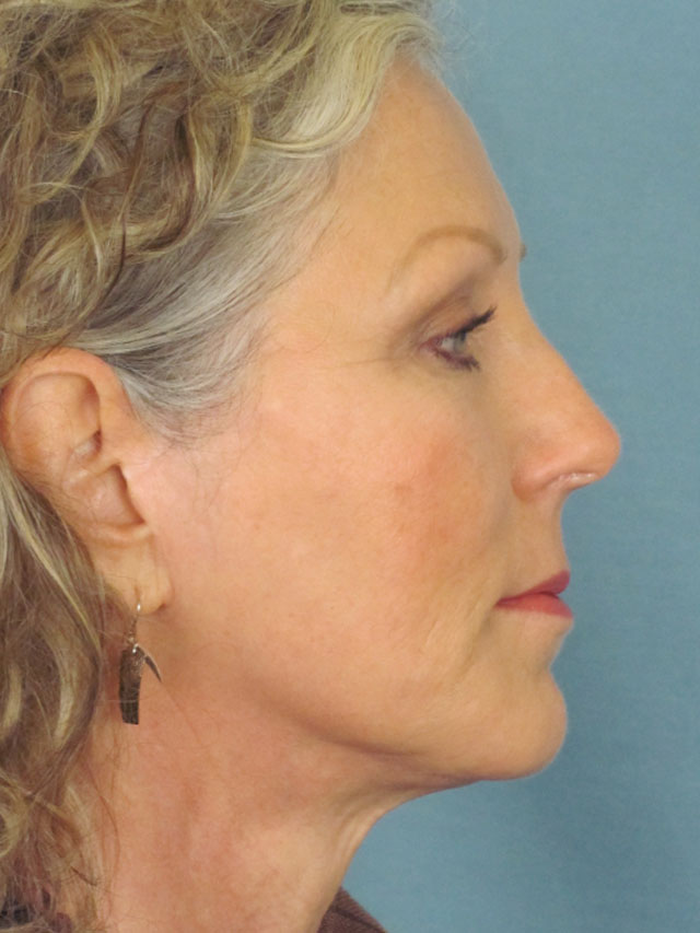 Charleston Custom Lift Facelift Before and After | Thomas Funcik MD