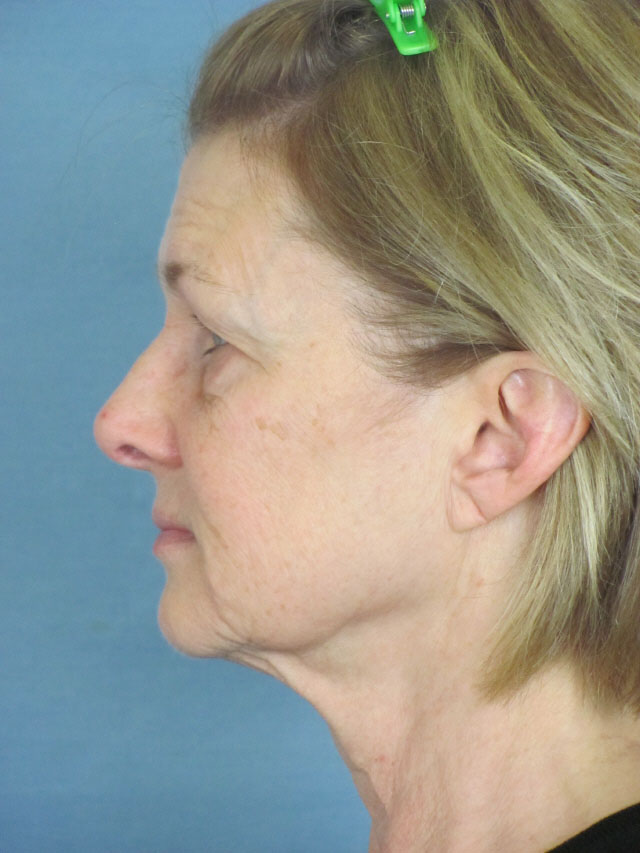 Charleston Custom Lift Facelift Before and After | Thomas Funcik MD