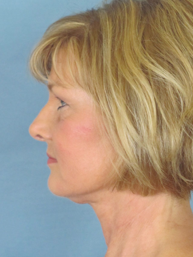 Charleston Custom Lift Facelift Before and After | Thomas Funcik MD