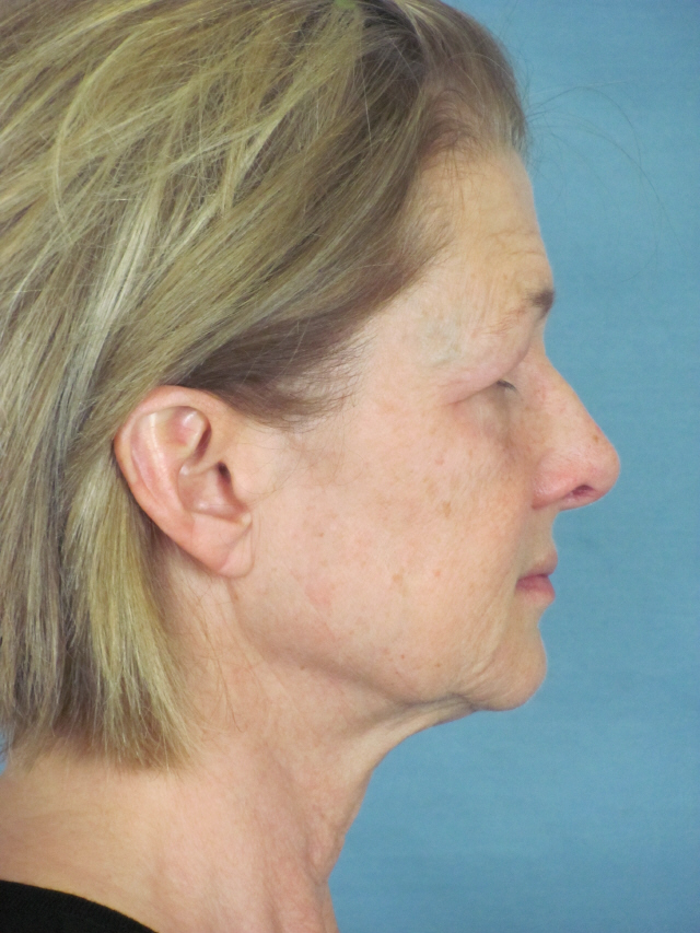 Charleston Custom Lift Facelift Before and After | Thomas Funcik MD