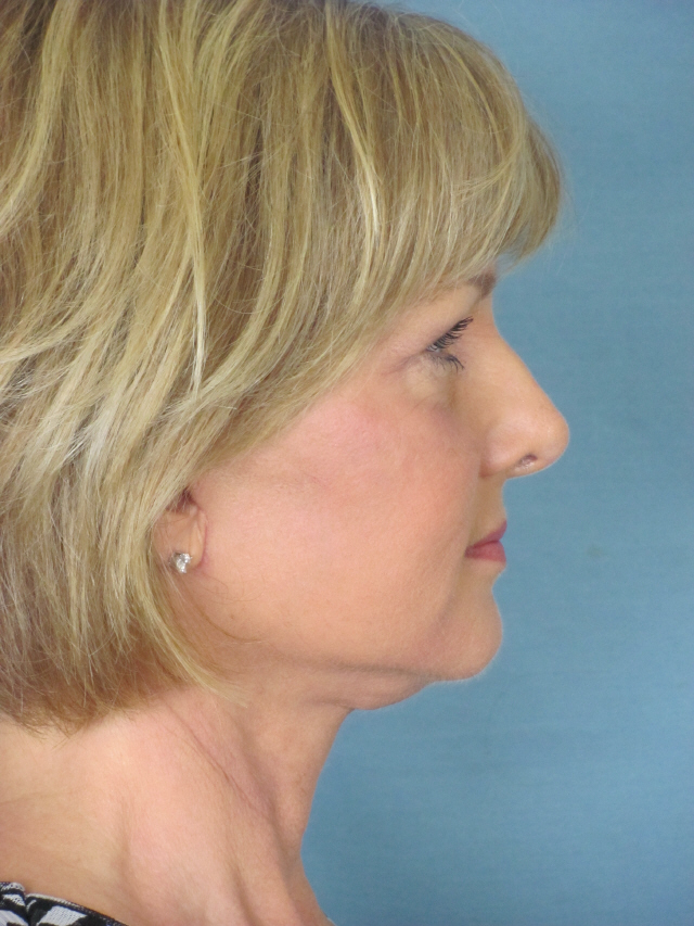 Charleston Custom Lift Facelift Before and After | Thomas Funcik MD