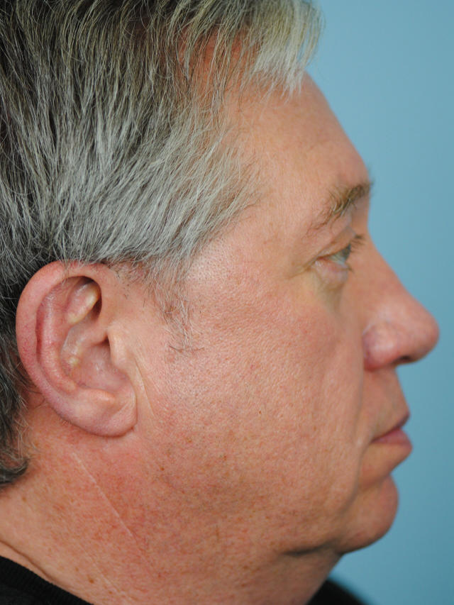 Charleston Custom Lift Facelift Before and After | Thomas Funcik MD